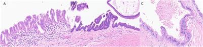 Updates in the Diagnosis of Intraductal Neoplasms of the Pancreas